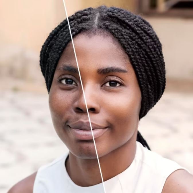 imag-article-melasma-01